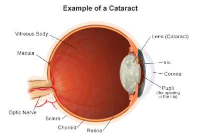 cataract.gif