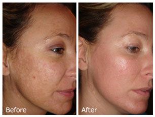 chemical-peel-before-and-after.jpeg
