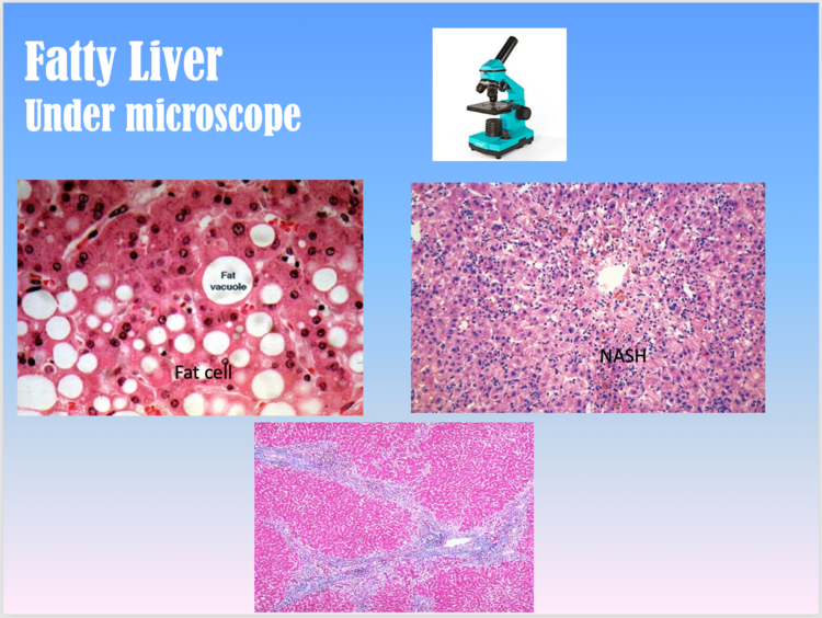 Fatty Liver Disease vs Cirrhosis vs Normal Liver Slide Under Microscope