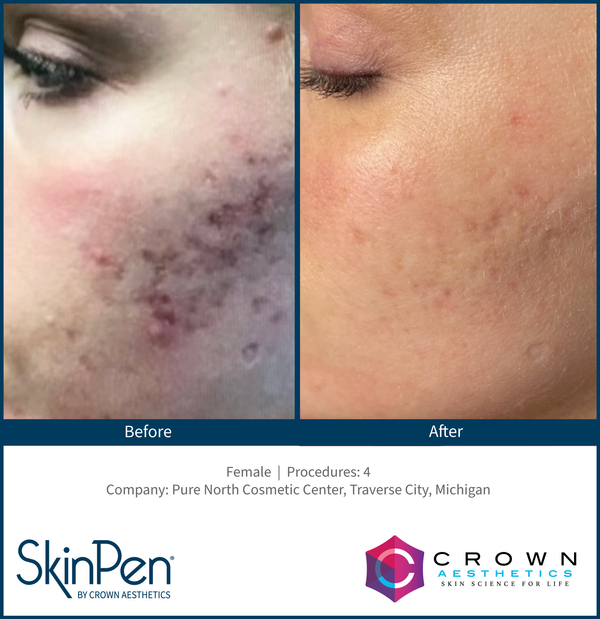 Before and After Acne Scar 4 treatment from SkinPen