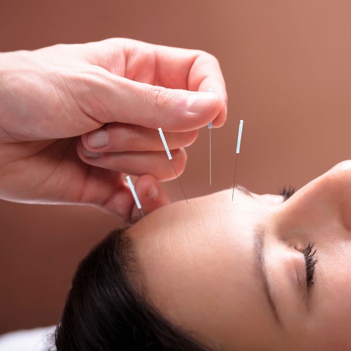 Acupuncture - Image 2.jpg
