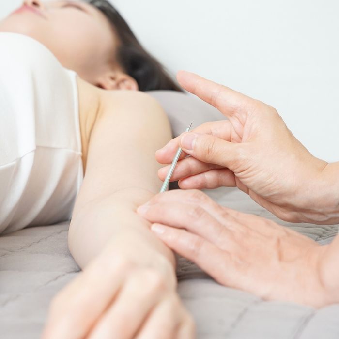 Acupuncture - Image 3.jpg