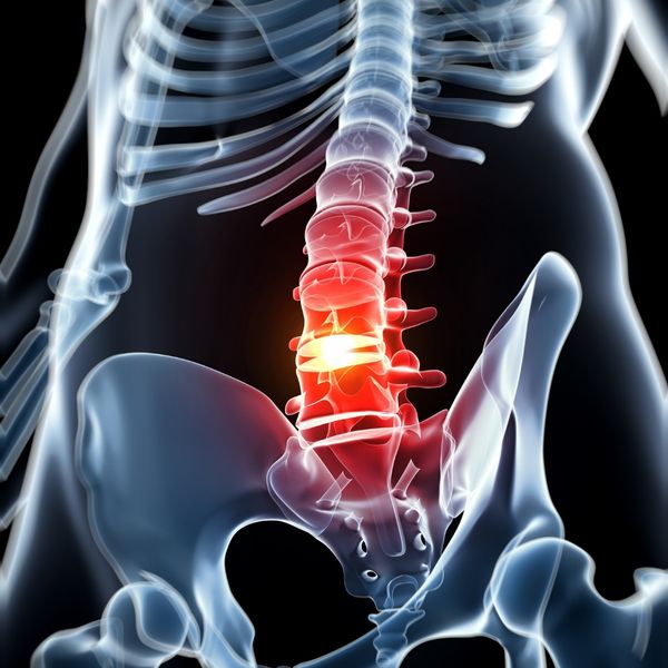 Degenerative Disc Disease - Image 2.jpg