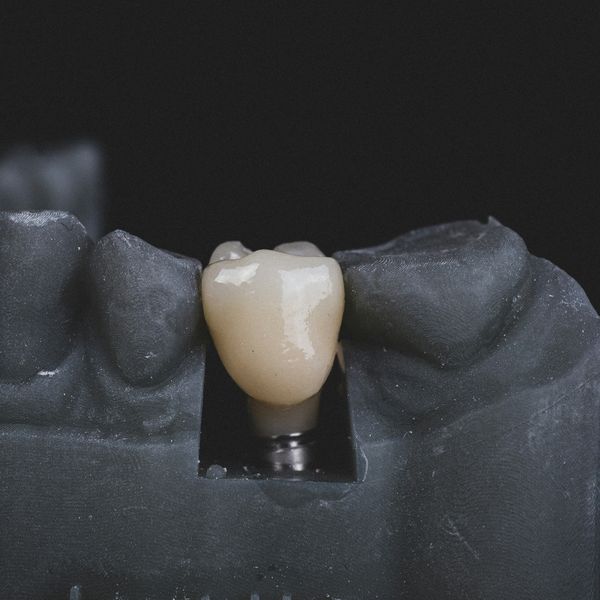 Single Tooth Dental Implants - Image 1.jpg