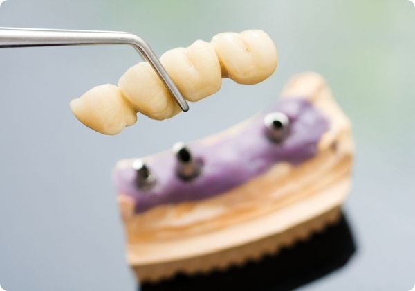 dental implants dental implants