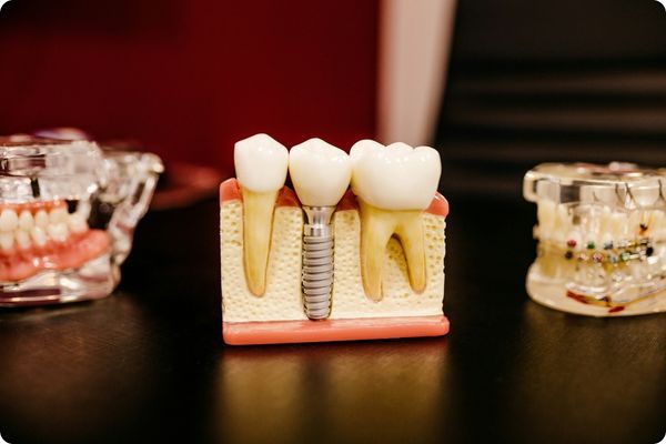 dental implants 1.jpg