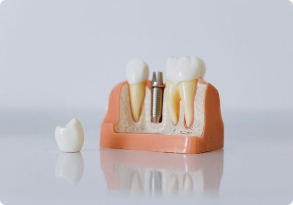 dental implant model dental implant model