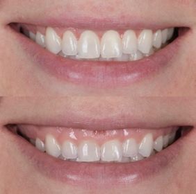 Crown Lengthening.jpg