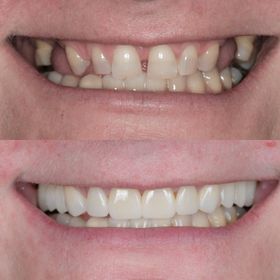 full mouth restoration.jpg