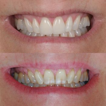 veneers1.jpg