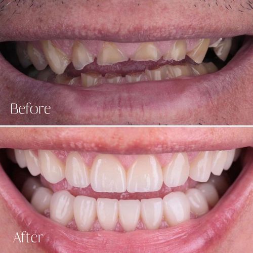 before and after mouth rehabilitation