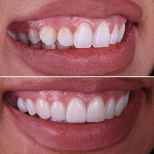 before and after of teeth