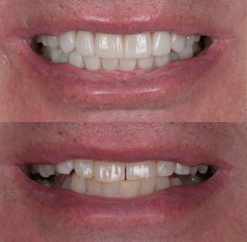 veneers.jpg