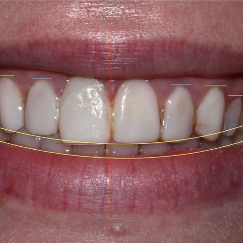 aligned teeth