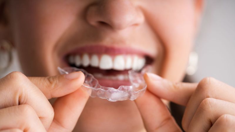 Invisalign vs Traditional Braces: Which is Better?