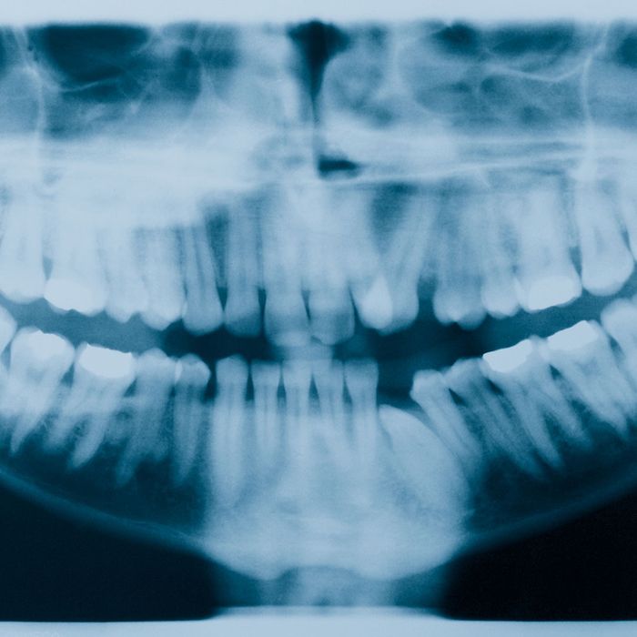 Post-2_Basics of Dental Crowns.jpg
