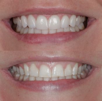 Dental Veneers in Boulder, Colorado Veneers