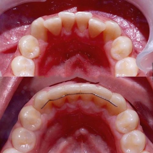 before and after dental alignment