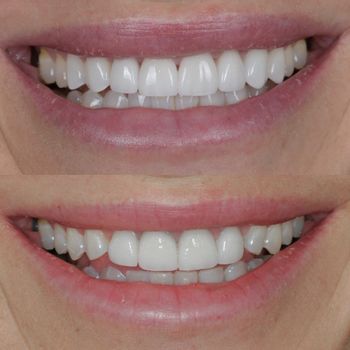 veneers.jpg