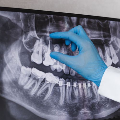 dental x rays