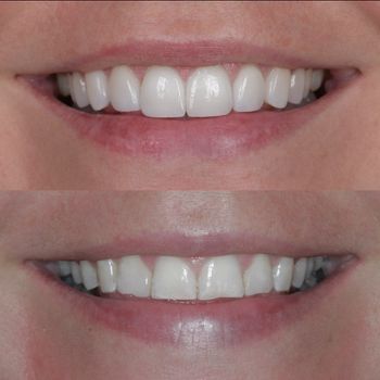 Dental Veneers in Boulder, Colorado Completed Veneers