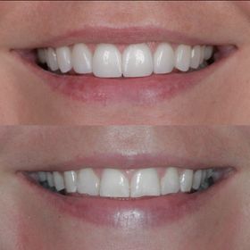Completed Veneers