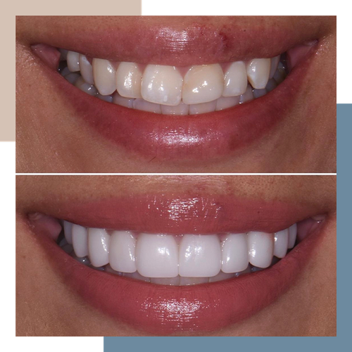 Invisalign Clear Braces in Boulder, CO