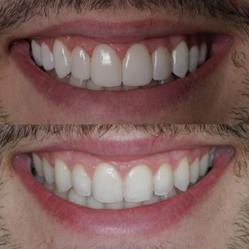 veneers2.jpg