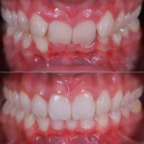 Photo showing a before and after of Invisalign results. 