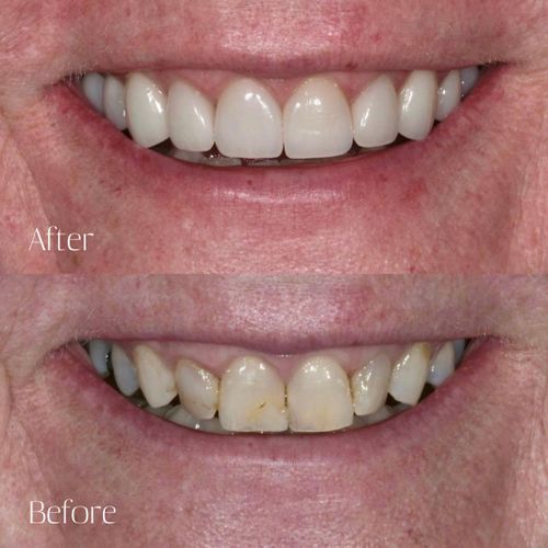 Before and after mouth rehabilitation