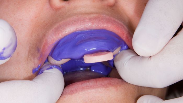 Person getting impressions done on their teeth. 
