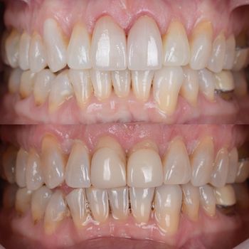 veneers2.jpg