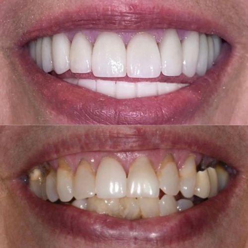 Before and after pictures of mouth rehabilitation. 
