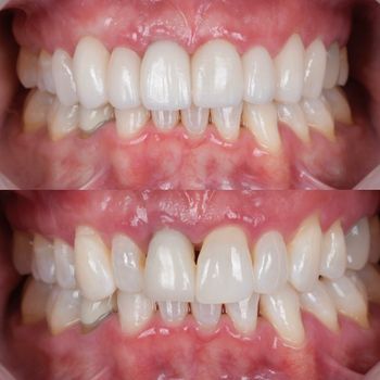 veneers.jpg