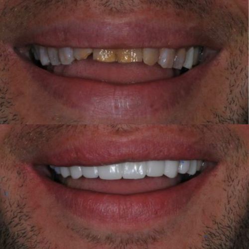 Before and after images of a patient with veneers. 