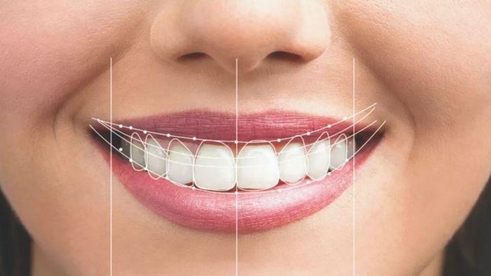Close up of smile with lines to show perfect teeth alignment