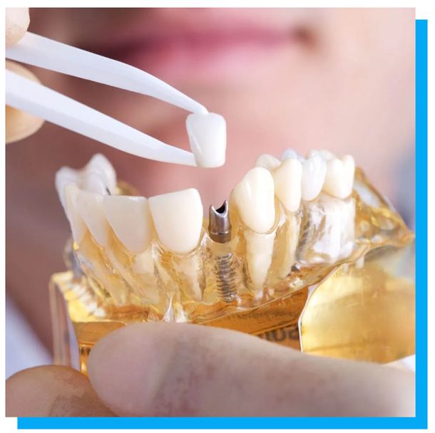 tooth implant model