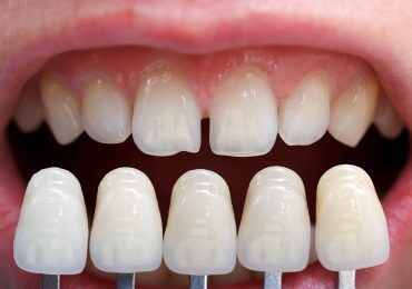 series of dental veneers