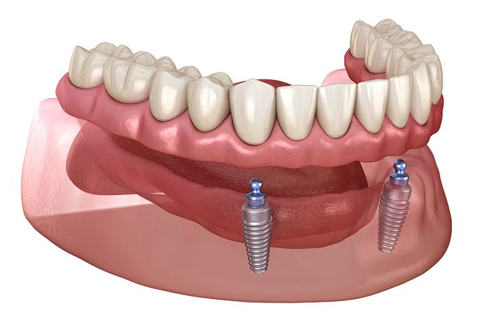 implant-supported-overdenture.jpeg