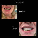 veneer-before-after-150x150.png