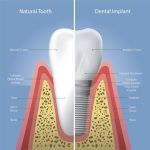 Dental-Implant-1-150x150.jpg