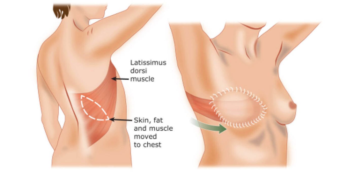 reconstruction-breast-cancer-latissimus-flap-1.jpg