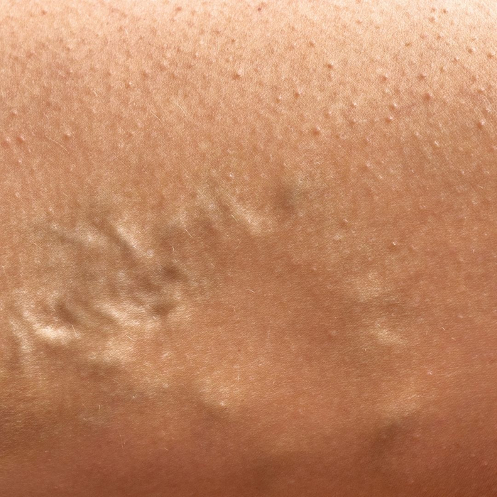 varicose veins