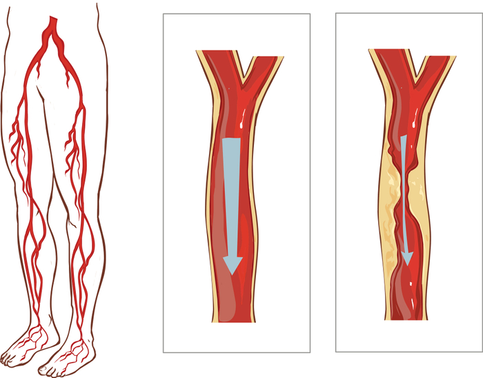 Calcified-Veins-Arteries-SKV.jpg