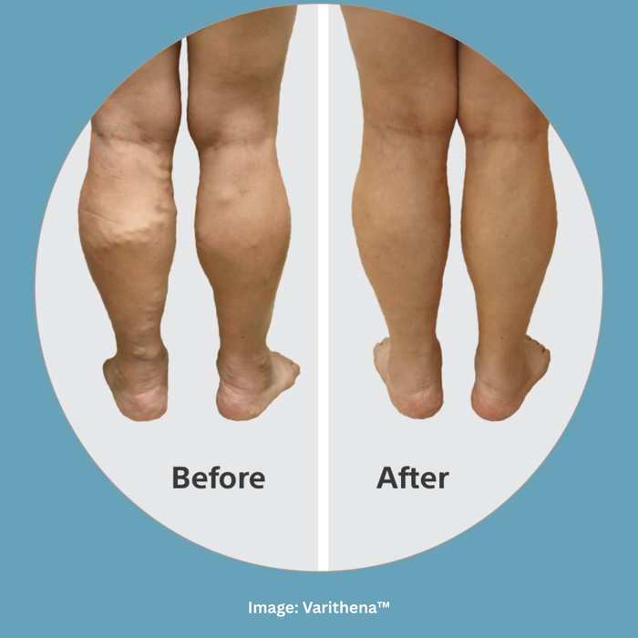 Varithena BeforeAfter.png