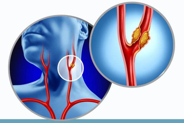 Carotid Artery Stenosis Treatment.png