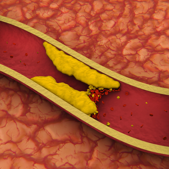 High Cholesterol in veins