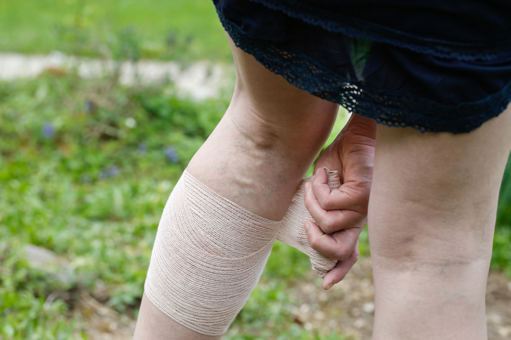 varicose-vein-treatment-southern-kentucky-vascular.jpg