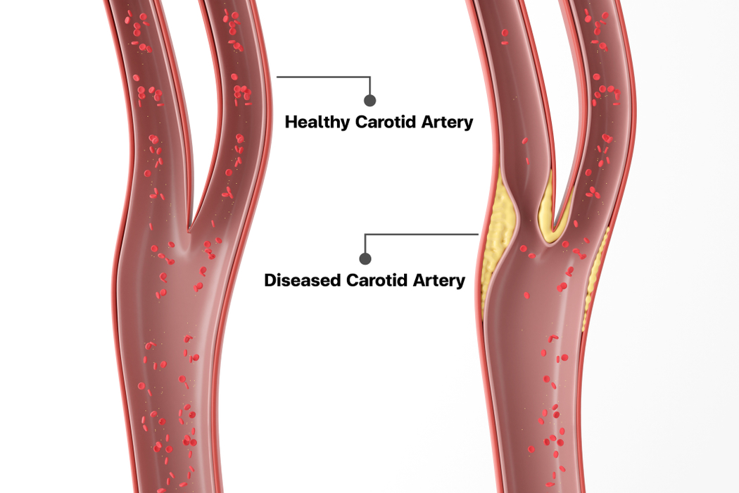 southern-kentucky-vascular-carotid-disease.jpg