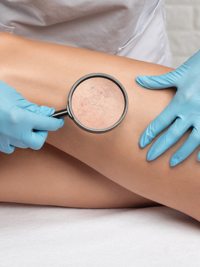 Sclerotherapy.jpg